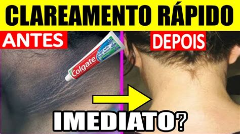 Como Tirar Roxo Do Pescoço Rapido Com Pasta De Dente - COMO CLAREAR O PESCOÇO E AXILAS COM PASTA DE DENTE - RECEITA BARATA QUE ...
