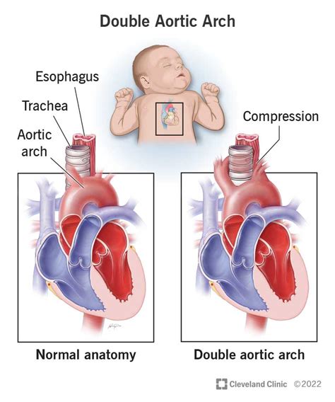 What Is A Double Aortic Arch