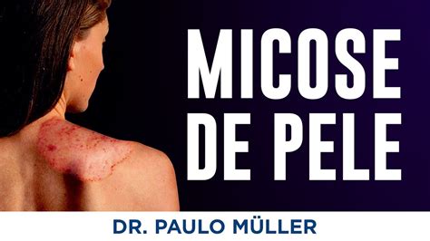 Micoses De Pele Dr Paulo M Ller Dermatologista Youtube