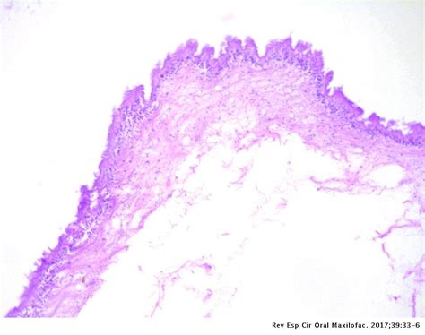 Oral Cysticercosis In The Paediatric Patient Report Of Six Cases