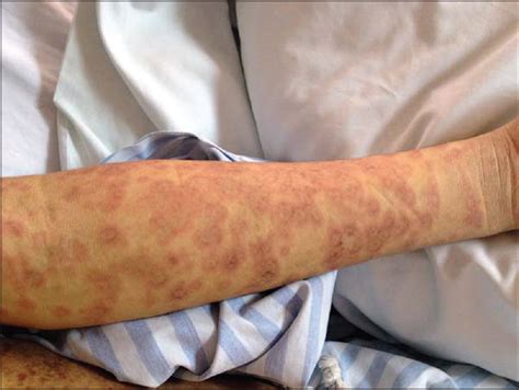 Erythema Multiforme Like Linear Immunoglobulin A Bullous Dermatosis