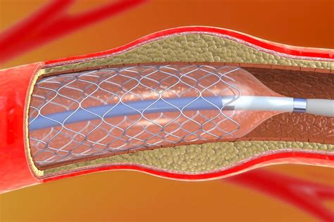 Angioplastia De Membros Inferiores Saiba Mais