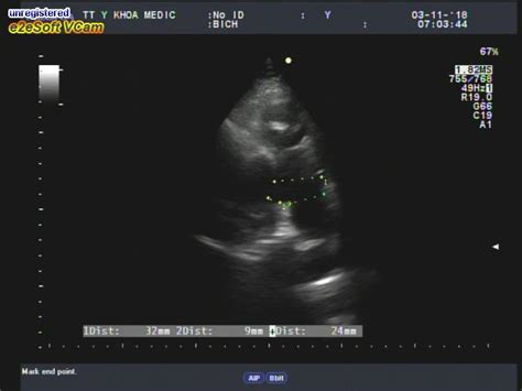 Pulmonary Valvular Endocarditis In The Patient With Pulmonary Stenosis A Case Report With Real