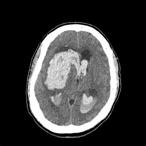 Hemorrhagic stroke CT - wikidoc