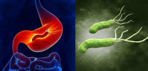 H Pylori Infection: Helicobacter Pylori Infection Symptoms Causes & More