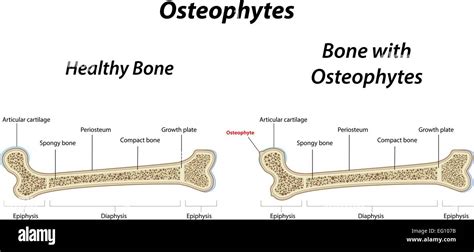 Osteophytes hi-res stock photography and images - Alamy