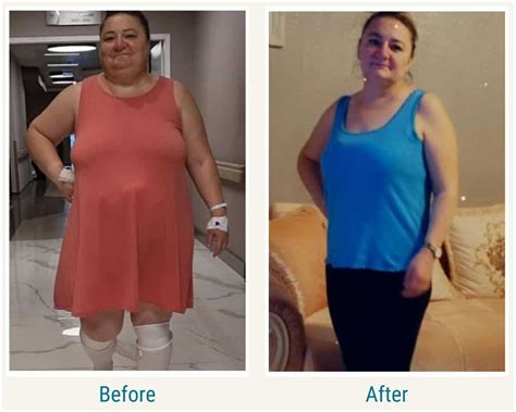 Gastric Sleeve Imed Medical