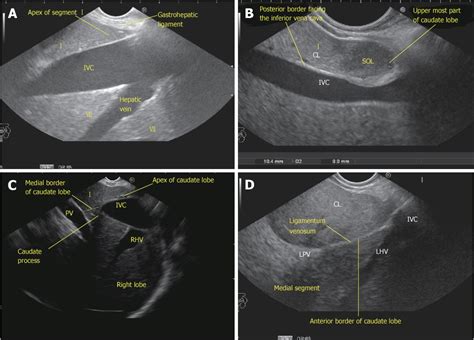 Normal Liver Ultrasound Labeled