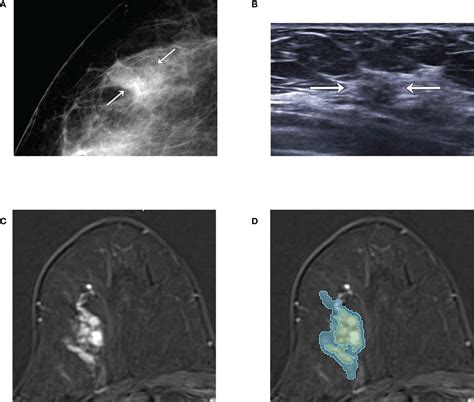 Frontiers Prediction Of The Histologic Upgrade Of Ductal Carcinoma In