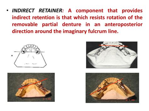 Solution Prosthodontic Indirect Retainers Studypool