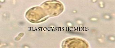 Blastocystis Hominis Tratamiento Casero Y Natural Remedios Caseros