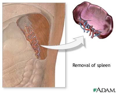 Spleen Removal Surgery