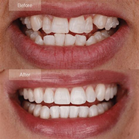 Teeth Straightening Invisalign Or Braces SavingSmiles