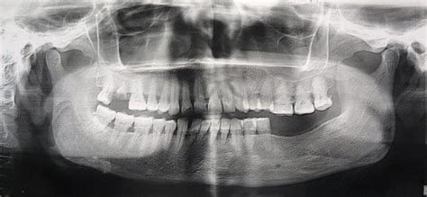 Moderate Periodontitis Radiograph