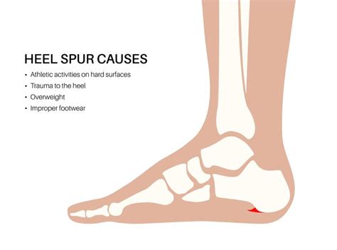 Premium Vector Calcaneal Spur Causes Foot Problem Diagnostic And