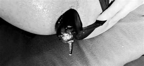 Eggplant In My Ass Hoanal Xhamster