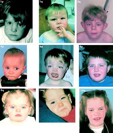 Синдром биндера фото