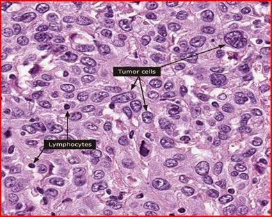 Cervical Cancer Histology