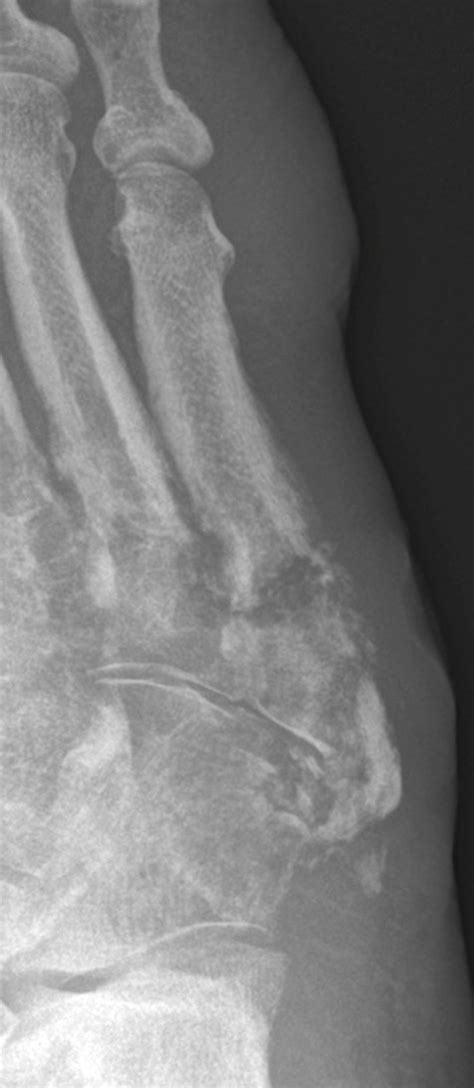 Osteomyelitis Radiology U Of U School Of Medicine