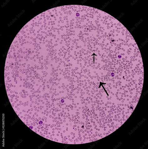 Blood smear show target cell and spherocytes. Hereditary spherocytosis