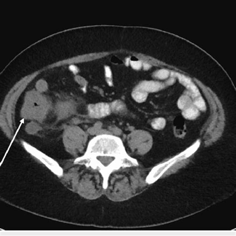 Ct Scan Of The Abdomen And Pelvis With Oral Contrast Axial Slice