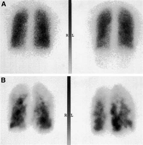 Ventilation Perfusion Scan Pulmonary Embolism