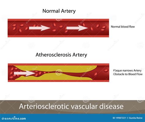 Atherosclerosis artery stock vector. Illustration of cells - 19987221