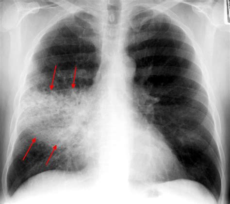 My Notes for USMLE — LOBAR PNEUMONIA