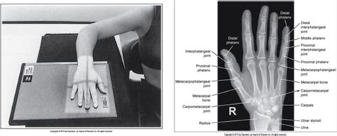 Image Analysis Upper Extremity Flashcards Quizlet