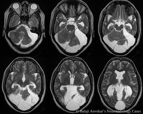 Dr Balaji Anvekar FRCR: Posterior Fossa Arachnoid cyst MRI