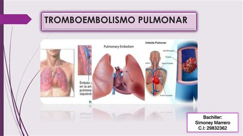 Tromboembolismo Pulmonar Simoney Udocz