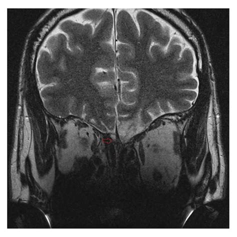 Mri Shows Irregular Hyperintensity Over Bilateral Rectus Gyri With