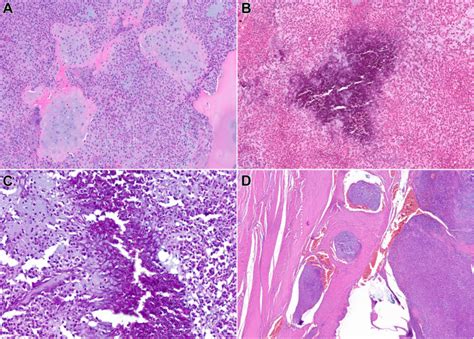 malignant chondroblastoma  epigenetically distinct subtype