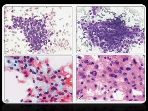 Role Of Cytology In Renal Lesions