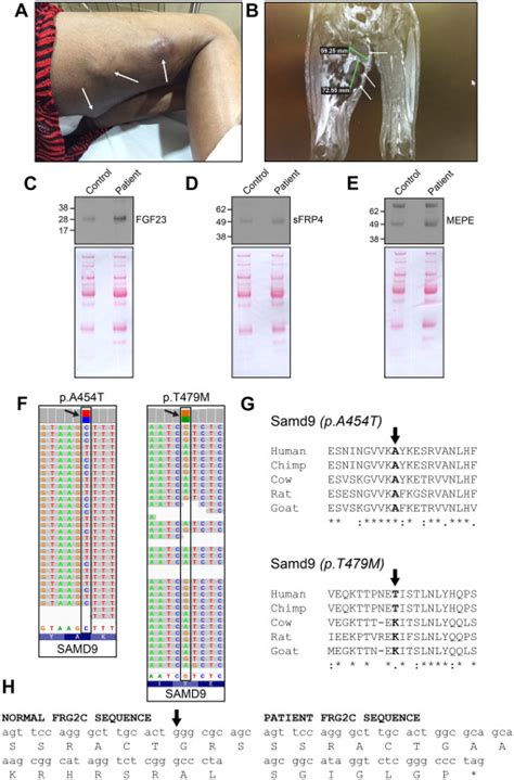 Alterations In SAMD9 AHSG FRG2C And FGFR4 Genes In A Case Of Late