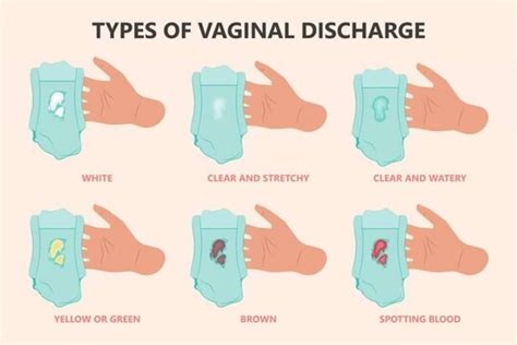 White Vaginal Discharge Before Period