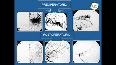 Neurorgs net Malformación vascular arteriovenosa cerebral MAV YouTube