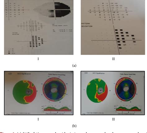 Figure From Prognostic Value Of Retinal Nerve Fiber Layer And