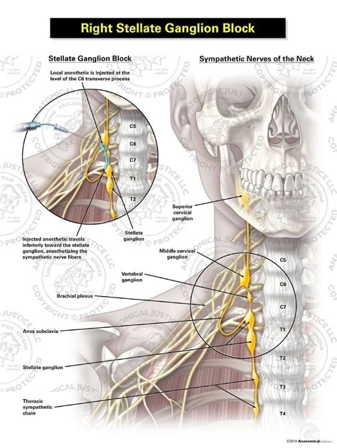 Female Right Stellate Ganglion Block