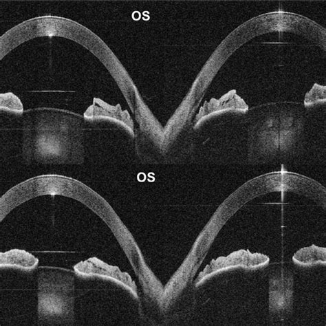 Automated Quantitative Pupillometry Using The Binocular Oct Prototype