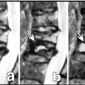 (PDF) The spectrum of vacuum phenomenon and gas in spine