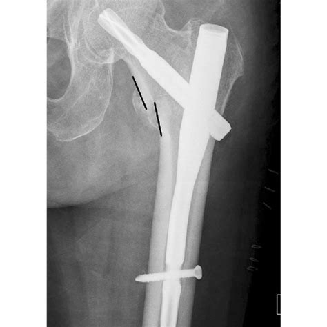 Pdf Fracture Reduction With Positive Medial Cortical Support A Key