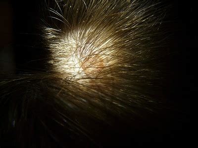 Scalp Conditions | UAMS News