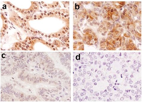 Paraffin Embedded Sections Of Benign Thyroid Nodules And Malignant