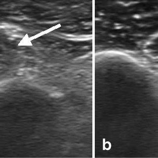 Short Axis Transverse Gray Scale Ultrasound Images A B Show Long