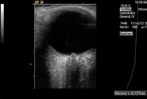 Papilledema Ultrasound