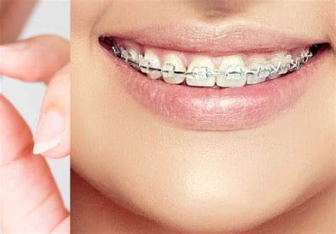 The Benefits Of Invisalign Braces A Guide For Beautiful Smiles