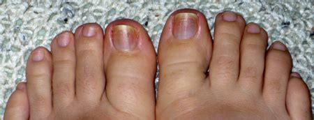 What causes dark toenails - Awesome Nail