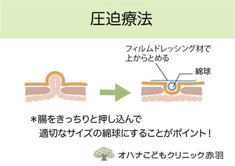 臍ヘルニア（出べそ）に対する圧迫療法について｜北区赤羽駅西口徒歩3分の小児科