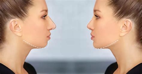 Genioplasty Chin Surgery Procedure And Complications